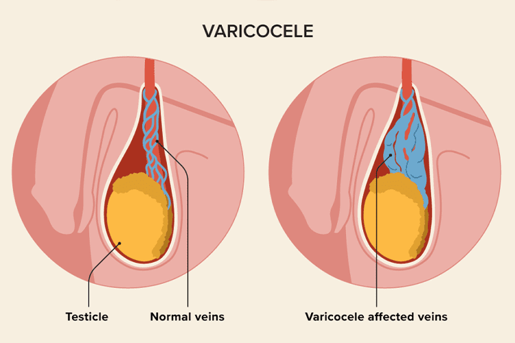 varicocele-problem