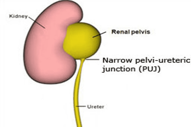 Narrowing of Pelvi-Ureteric Jundtion(PUJ)
